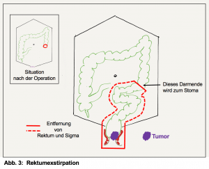 Entfernung des Rektums