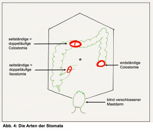 Verschiedene Stoma Arten