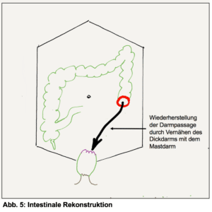 Stoma Rückoperation - Intestinale Rekontruktion