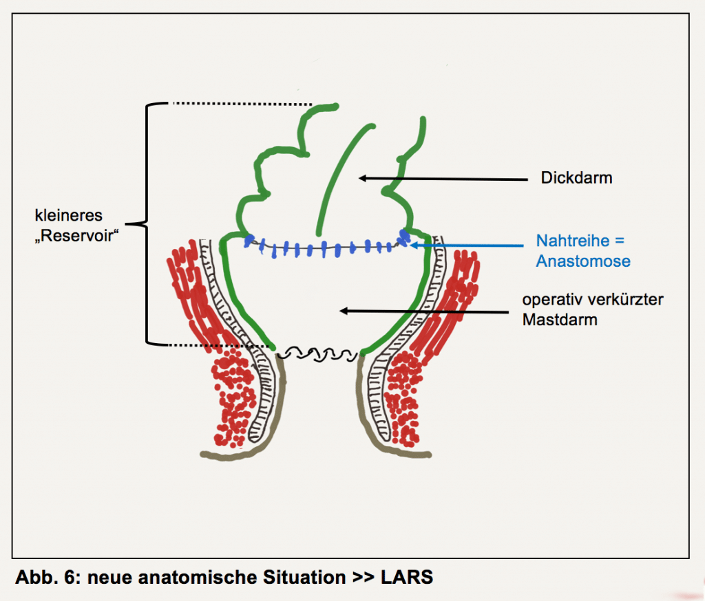 Bedingungen Stoma Rückoperation