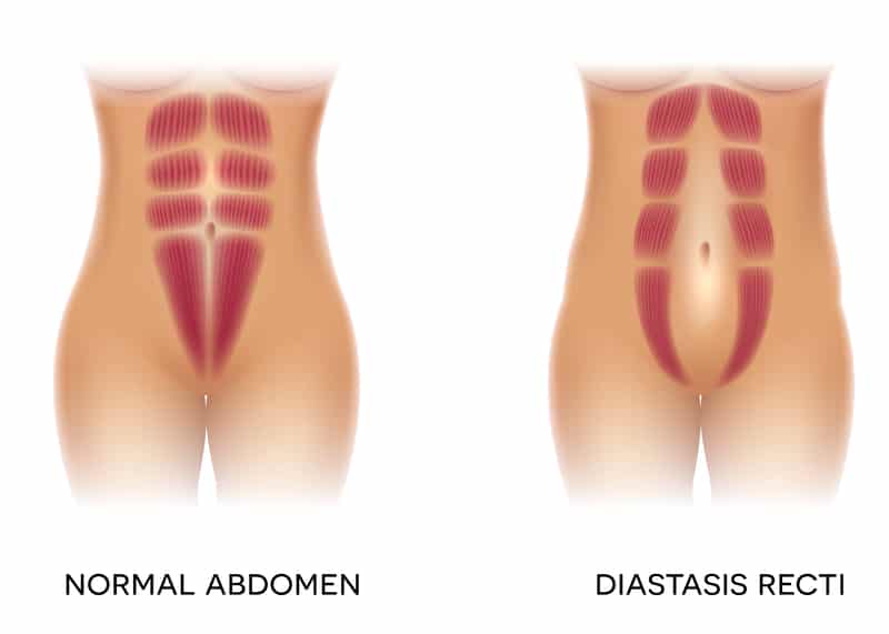 Bauchmuskeln nach Schwangerschaft